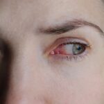 marco loiodice oculista congiuntivite