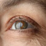 centro medico oculistico loiodice cataratta corato