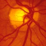 esame fondus oculi e diabete presso oculistica loiodice corato