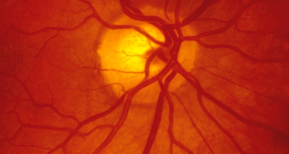 esame fondus oculi e diabete presso oculistica loiodice corato