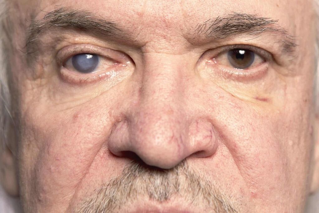 oculistica-loiodice-corato-glaucoma