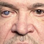 oculistica-loiodice-corato-glaucoma