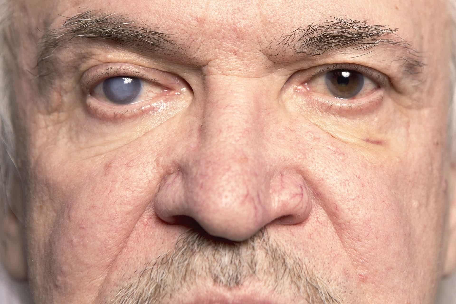 oculistica-loiodice-corato-glaucoma